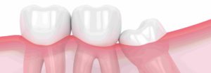 Dents de sagesse